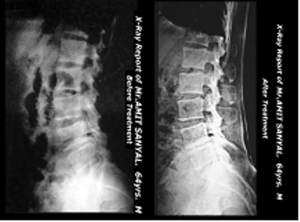 OPTM Health Care-Before & After Treatment of Lumbar Spondylosis